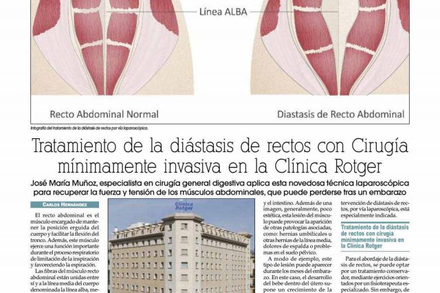Cirugía Mínimamente Invasiva para el tratamiento de la Diástasis de Rectos en Clínica Rotger