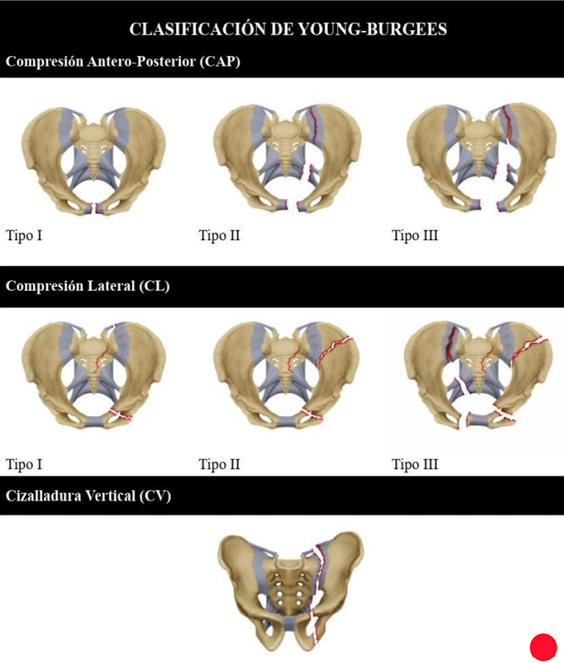 Clasificación de Young-Burgees