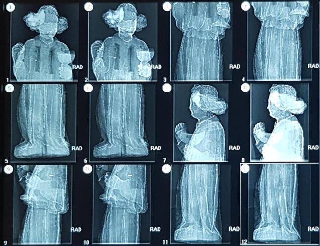 Ángeles de la Seu Clínica Rotger Hospital Mallorca