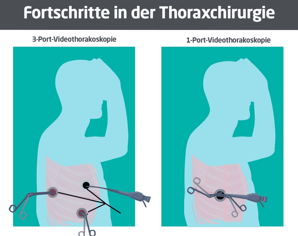 Cirugia-Toracica Dr-Francisco-Carrera