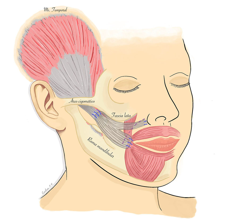 Reconstrucción de la intervención