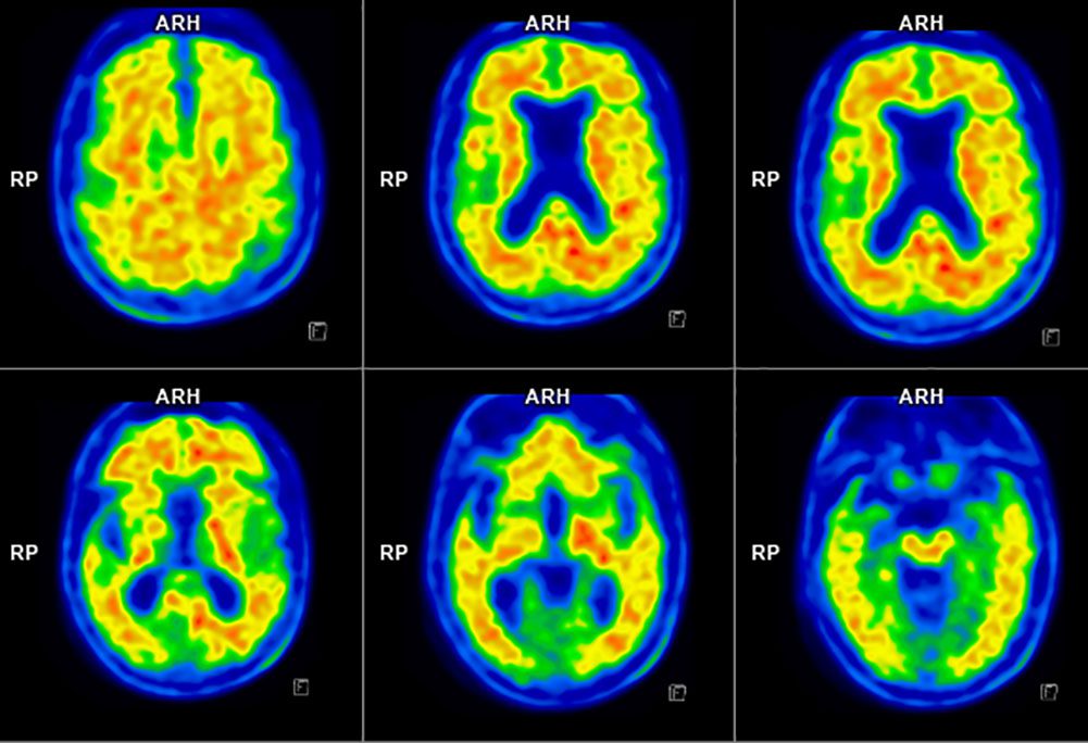 PET-TC cerebral con beta amiloide